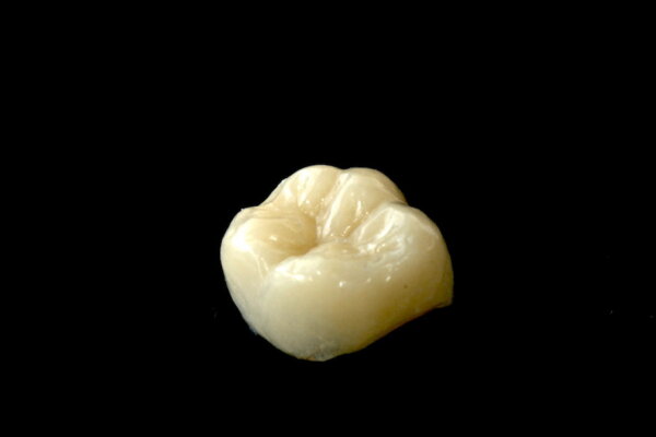 仮歯の（仮）じゃない大切なお話